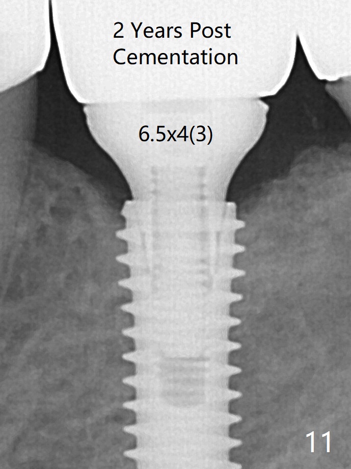 Non Immediate Implant of Lower 1st Molar with Ridge Split, Duluth